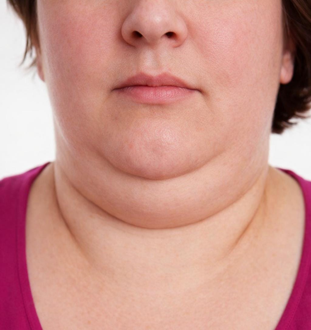 Double Chin